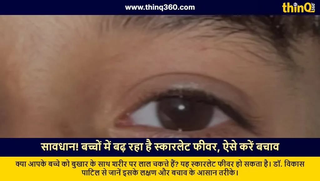 scarlet fever symptoms prevention tips kids